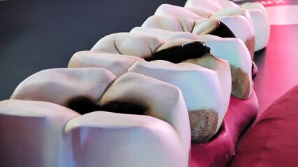 Dental educational model showing tooth decay and advanced caries problem