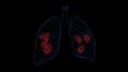 tuberculosis infection on lung x-ray video