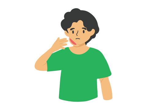 Mumps Disease or Parotitis in Cheek
