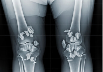 x ray image of knee
