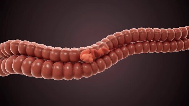 Intestinal Intussusception Medical Animation Depicting Bowel Obstruction and Telescoping of the Gut Anatomy