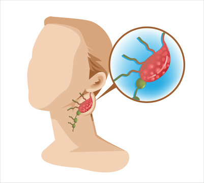 Swollen Lymph Node Cervical Lymphadenitis