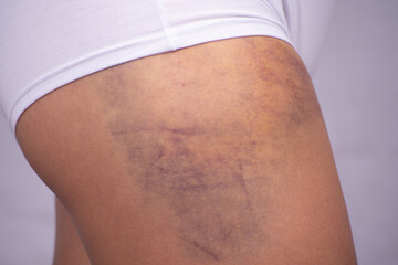 Large hematoma on a woman's leg