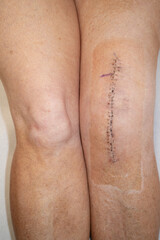 Woman's knee after knee replacement operation, no dressing, showing surgical staples.