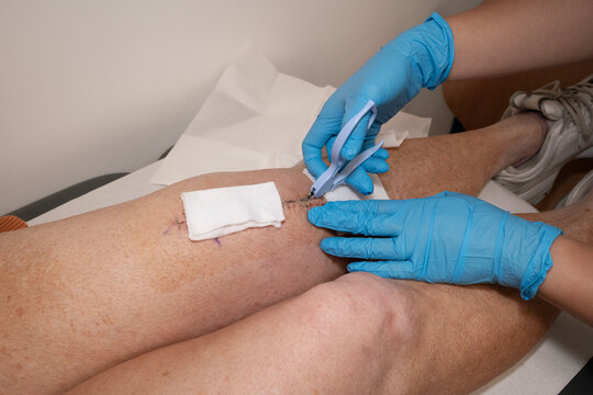 Surgical staples being removed by nurse from woman's knee after knee replacement operation.