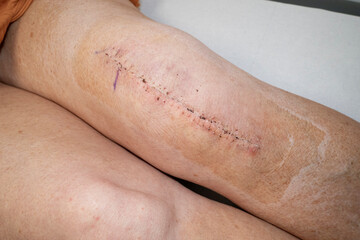 Fototapeta premium Woman's knee after knee replacement operation, surgical staples removed.