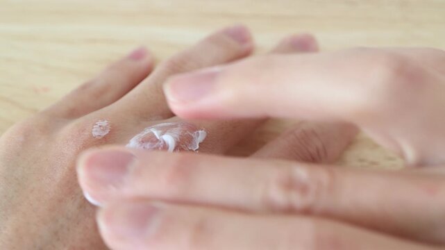 乾燥であかぎれした手に保湿クリームを塗る様子。