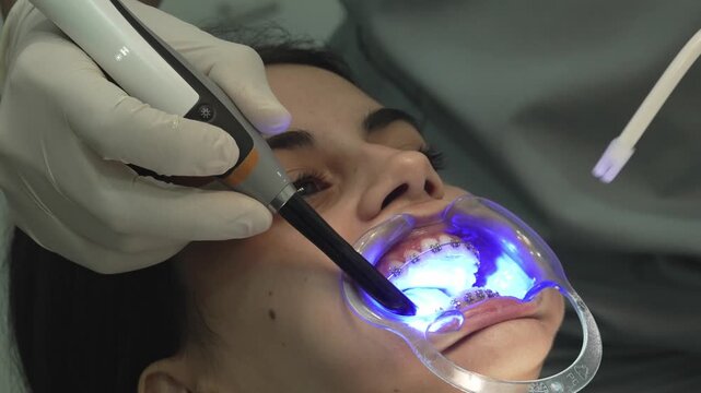 Orthodontist curing dental braces with uv light