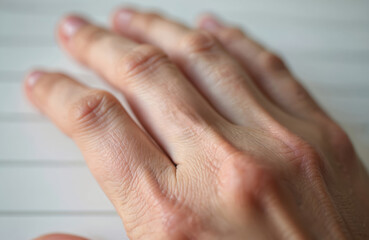 Close up of common wart on person finger knuckle. Skin disease problem visible on human hand. This health issue needs treatment by doctor. Dermatology patient has viral infection, affecting skin.