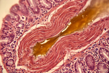 Fototapeta premium Microscopic Histology of Sphincter of Oddi Spasm: Smooth Muscle Hypertonia Constricting Bile Duct Lumen (SOD Pathology)