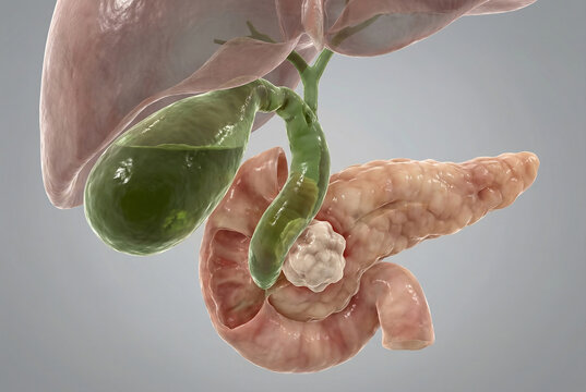 Courvoisier's Sign Pathology: Pancreatic Head Tumor Causing Common Bile Duct Obstruction and Hydrops of Gallbladder