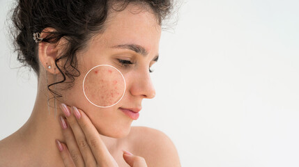 Portrait of a young girl with pimples and acne on face close up on white background. Woman with problematic skin. Collage of problem skin before and after treatment and care