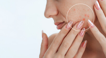 close-up female face with pimples and red acne on a white isolated background. Woman with problematic skin. Collage of problem skin before and after treatment and care. Clean healthy and bad skin