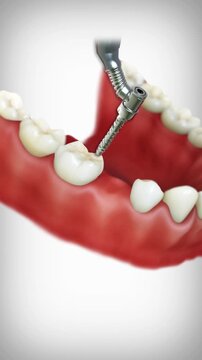 Porcelain fused to metal (PFM) dental bridge placement. Medically accurate 3D dental animation.