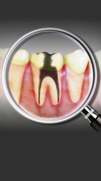 Endodontic root canal infection process. Medically accurate tooth 3D animation.