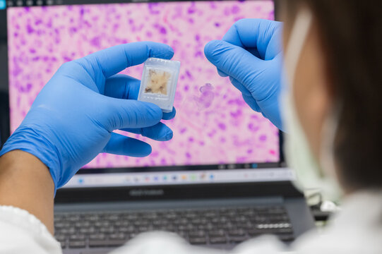 Scientist wear blue glove holding glasses slide and human tissue block and out of focus computer monitor show glandular image from microscope.Medical patholology and cytology laboratory technology 
