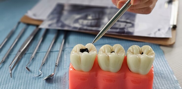 Dentist demonstrating procedure on dental model during dental exam to educate patients about cavity treatment concept