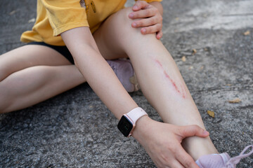 Minor leg injury with scrape after falling on pavement. Concept of accident, safety awareness, first aid, outdoor activity risk, health care, recovery and everyday lifestyle incident.