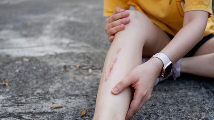 Minor leg injury with scrape after falling on pavement. Concept of accident, safety awareness, first aid, outdoor activity risk, health care, recovery and everyday lifestyle incident.