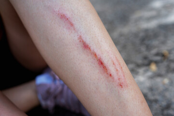 Fototapeta premium Minor leg injury with scrape after falling on pavement. Concept of accident, safety awareness, first aid, outdoor activity risk, health care, recovery and everyday lifestyle incident.