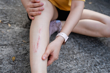 Minor leg injury with scrape after falling on pavement. Concept of accident, safety awareness, first aid, outdoor activity risk, health care, recovery and everyday lifestyle incident.