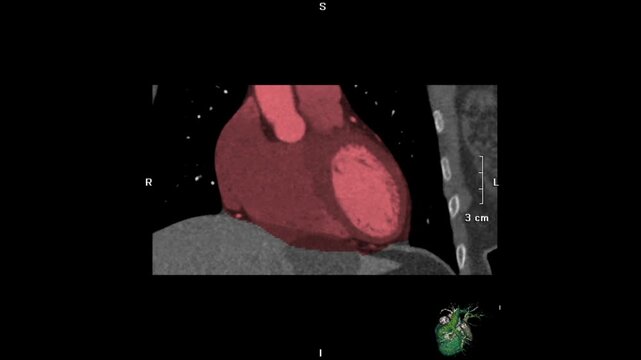 Medical video showing multiplanar reconstruction (MPR) CT scan with sagittal, coronal, and axial views, illustrating detailed human head anatomy for radiology, diagnostic imaging, and medical educatio