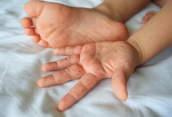 Hand-foot-and-mouth disease (HFMD) rash and blisters on a child's hand and sole.