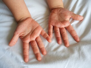 Hand-foot-and-mouth disease (HFMD) rash and blisters on a child's hand and sole.