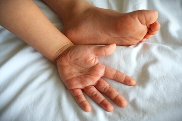 Hand-foot-and-mouth disease (HFMD) rash and blisters on a child's hand and sole.