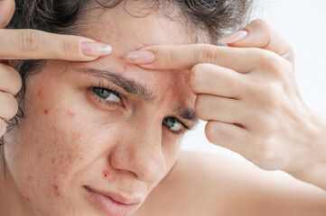 close-up portrait of woman face with pimples and acne. A young girl squeezes out inflamed red pimples on the skin of face with fingers on white background