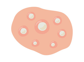 Acne Whitehead in Skin