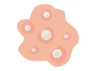 Acne Whitehead in Skin illustration