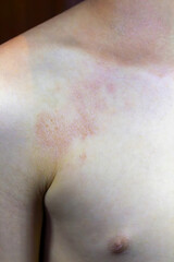 Fototapeta premium Atopic dermatitis skin rash on upper chest and shoulder area close up