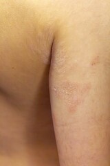Fototapeta premium Atopic dermatitis skin inflammation on arm close up detailed view