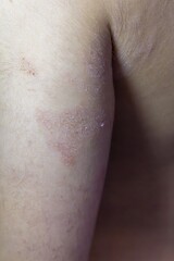 Fototapeta premium Atopic dermatitis skin rash close up on child’s arm showing inflammation and irritation