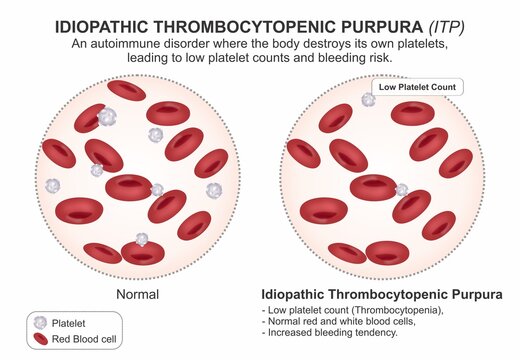 Idiopathic Thrombocytopenic Purpura (ITP) Medical Infographic Flashcard