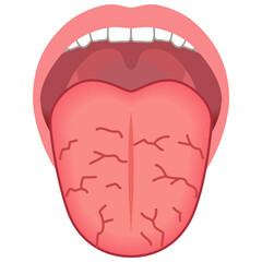 ひび割れた舌　舌でわかる健康状態　舌診　舌の健康