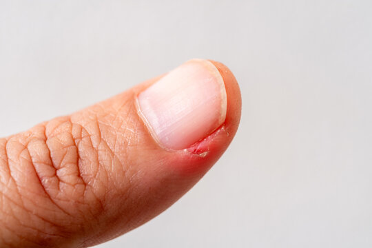 Human fingernail with redness and minor wound around the cuticle, showing nail infection, hangnail irritation, or paronychia. Medical health concept, skin problem detail. macrophoto