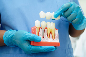Doctor hold dental implant, artificial tooth roots into jaw, root canal of dental treatment, gum disease, teeth model for dentist studying about dentistry.