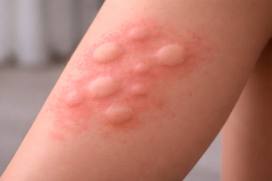3D realistic hives on the back or shoulder, medium crop showing scattered transient wheals of varying sizes, slightly elevated and smooth with mild redness, skin fully intact