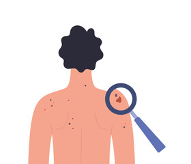 Dermatology screening. Dermatoscopy examination. Skin cancer diagnosis of a man. Healthcare vector illustration