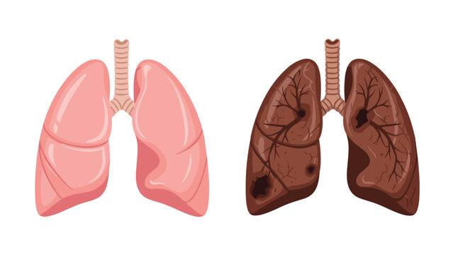 Illustration comparing healthy pink lungs to damaged dark lungs showing effects of smoking or disease, highlighting respiratory health.