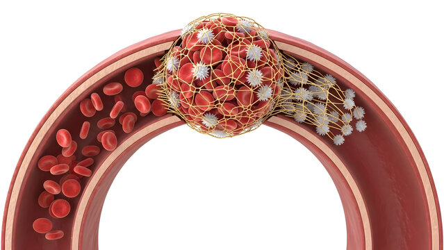 Blood Clot Blocking Artery Vessel Flow Thrombus Embolism