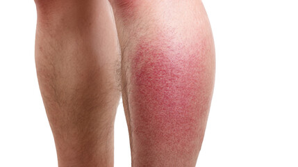 Red rash showing symptoms of cellulitis affecting a woman's leg, isolated on transparent background, ideal for medical and healthcare publications