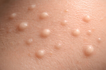 Fototapeta premium Photorealistic 3D depiction of comedonal acne (blackheads and whiteheads), close-up of cheek and nose-area skin only, multiple small closed comedones and a few open comedones