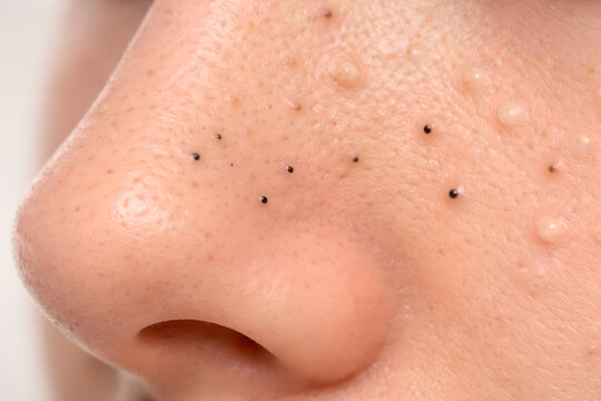 Photorealistic 3D depiction of comedonal acne (blackheads and whiteheads), close-up of cheek and nose-area skin only, multiple small closed comedones and a few open comedones