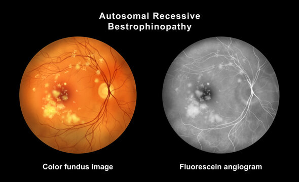 Autosomal recessive bestrophinopathy, illustration
