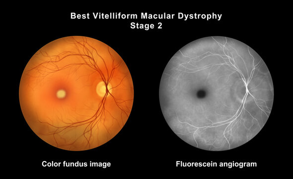 Best disease stage 2, illustration