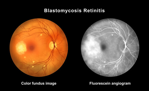 Ocular blastomycosis, illustration
