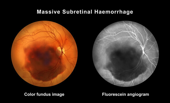 Massive subretinal hemorrhage, illustration
